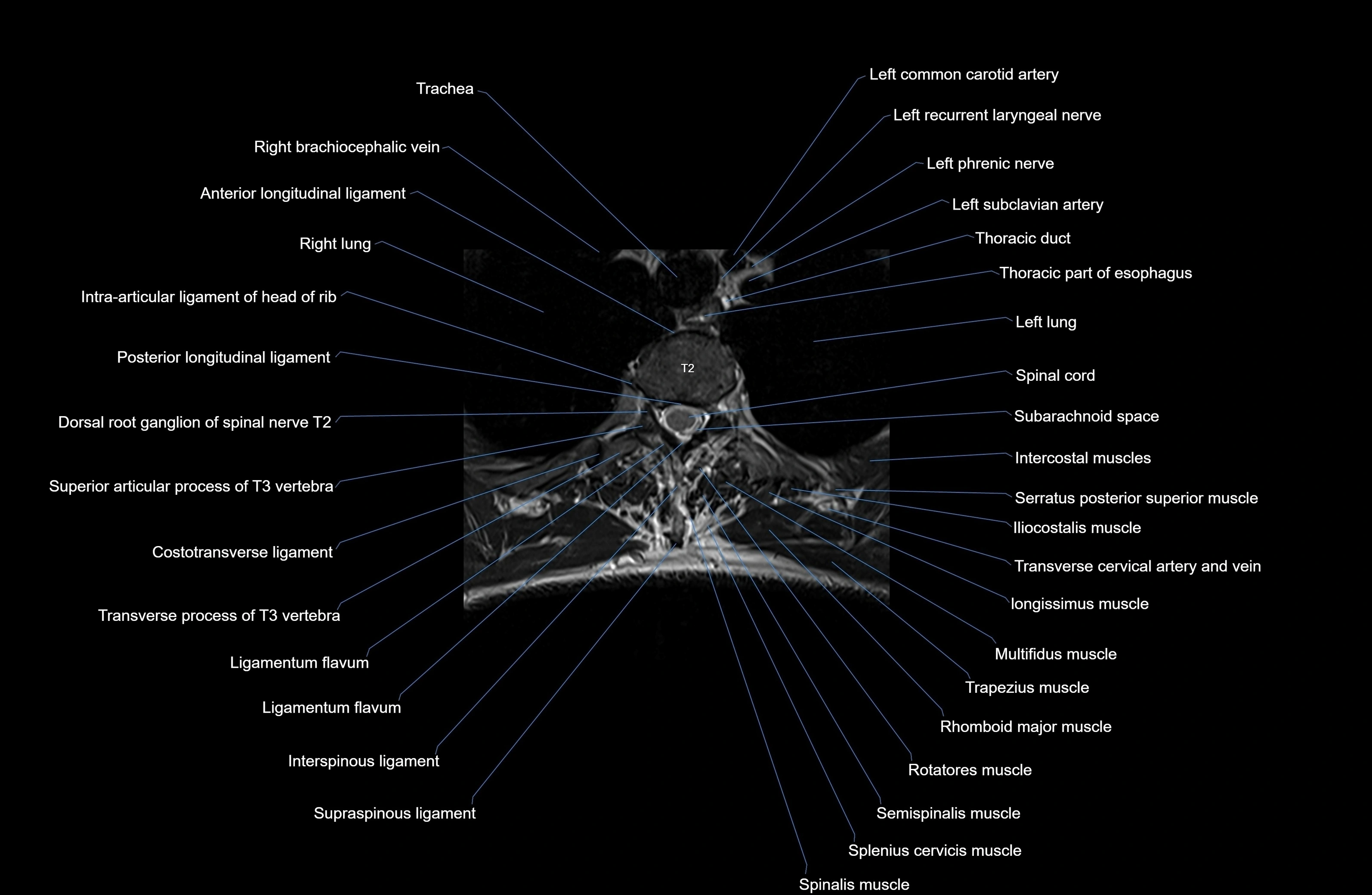 MRI thoracic spine axial  cross sectional anatomy 3T radiology  image-img-00001-00017.webp